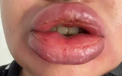 Nutricionista vai pagar R$ 35 mil para retirar preenchedor sintético dos lábios